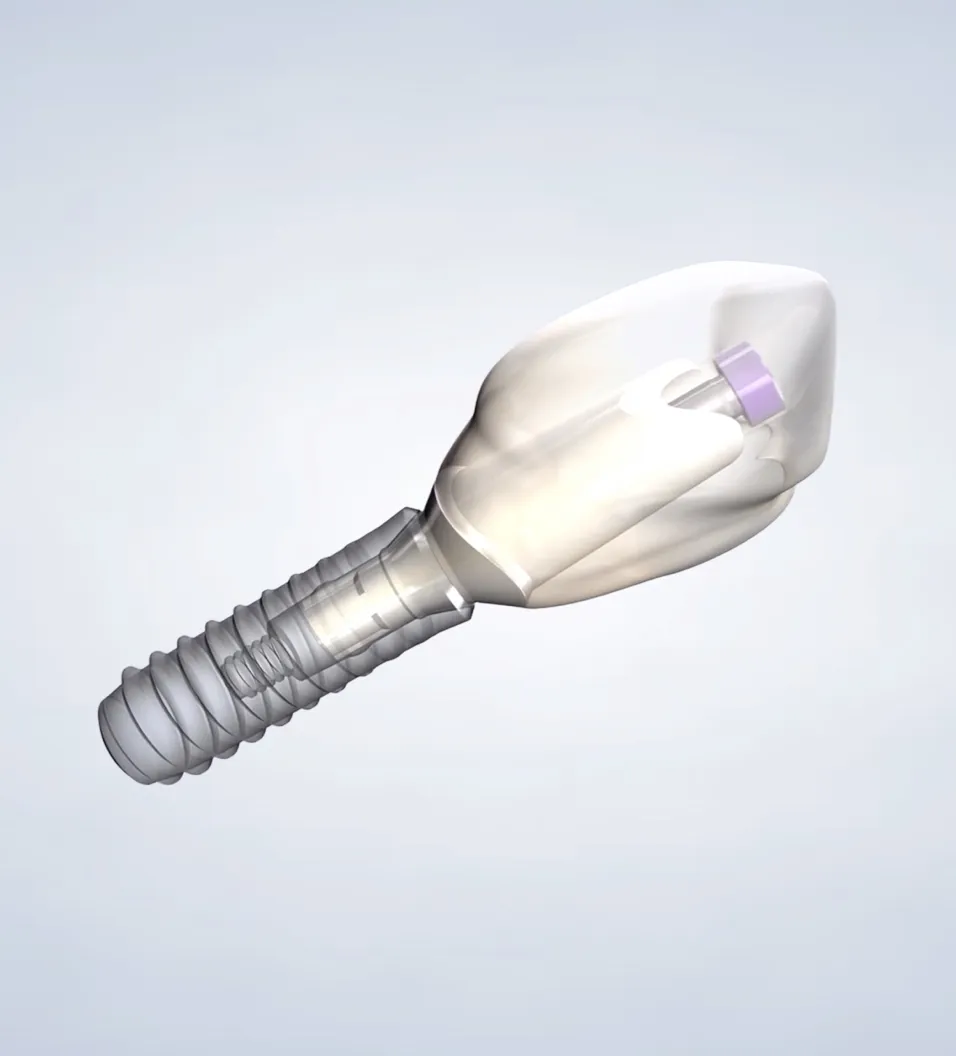 Query  dental implants