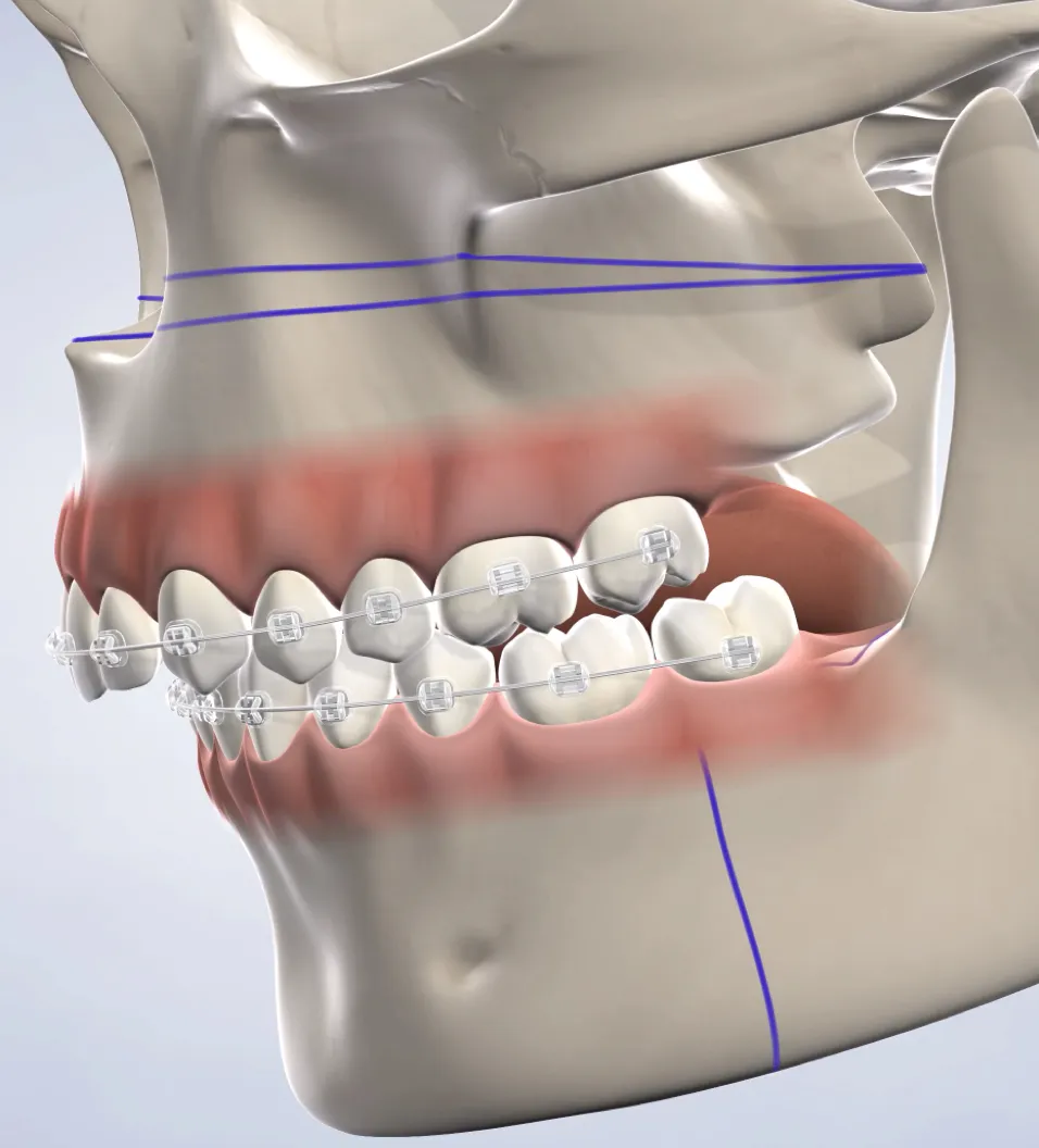 Query  orthognathic jaw surgery
