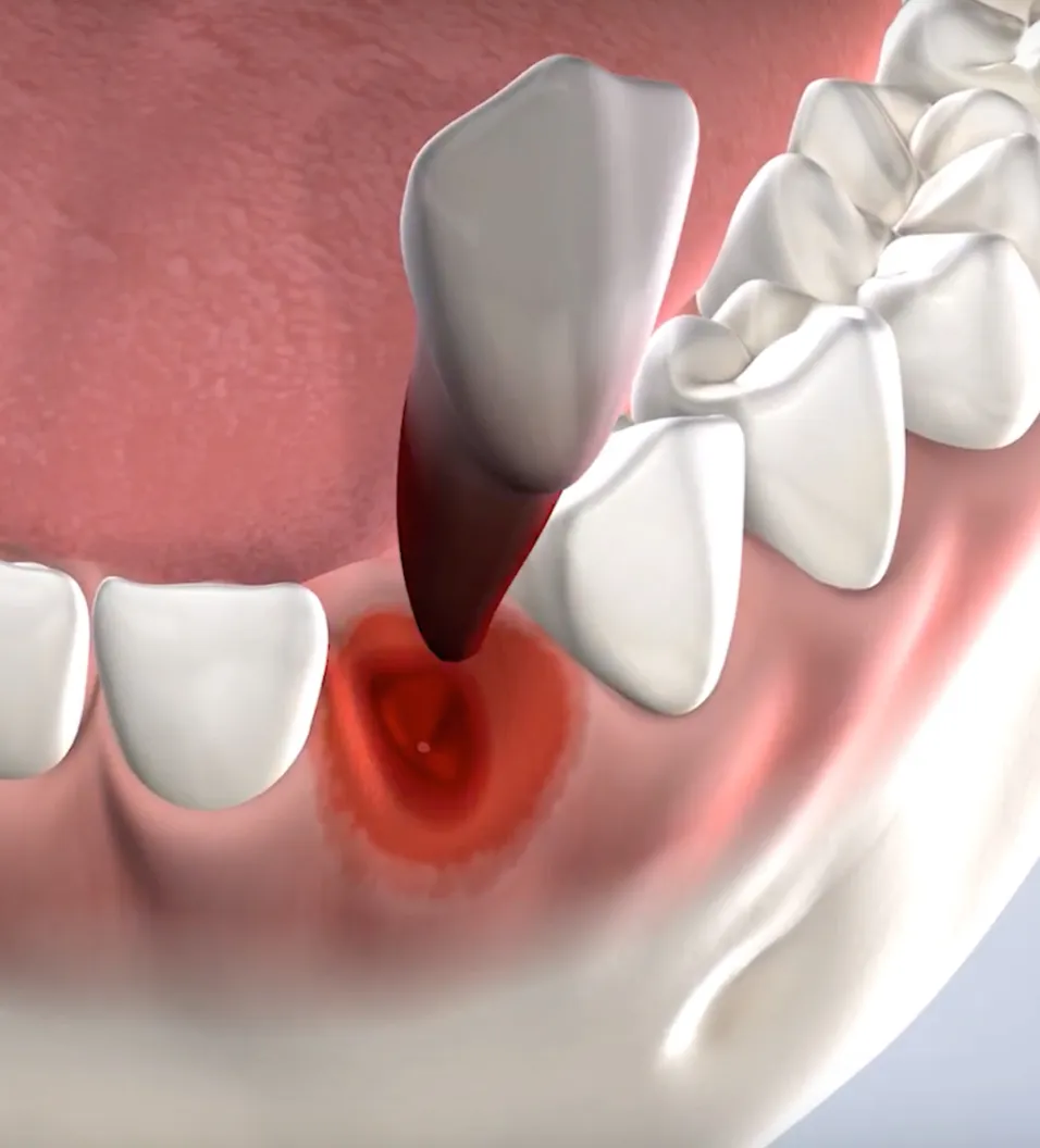Query  tooth extraction